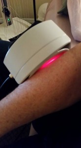 Dr. David Rindge's laser on my arm 
